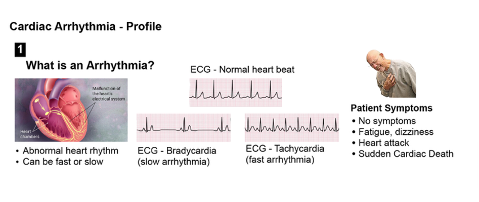 A scientific image explaining cardiac arrhythmia and common symptoms